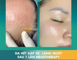 Meso Glow Therapy
