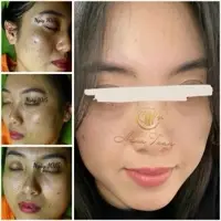 Advanced Acne Solution