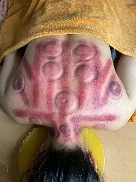 Detox Cupping Therapy