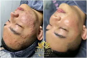 Lấy nhân mụn chuyên sâu chuẩn y khoa