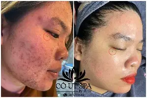 Combo lấy mụn chăm sóc da
