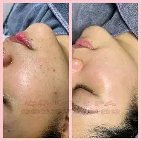 Mầm nhũ tương căng bóng