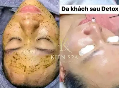 Thanh lọc da