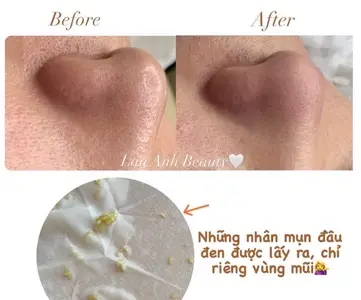 Lấy nhân mụn