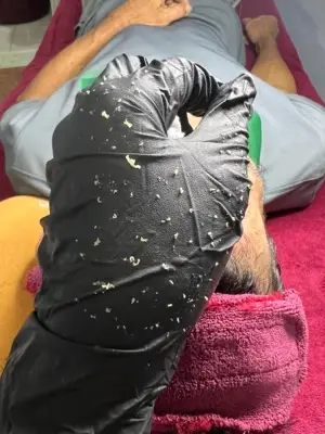Lấy mụn