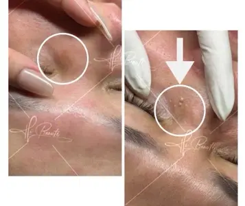 Mụn chuyên sâu  - Probiotic