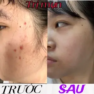 Trị mụn