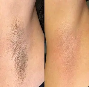 Underarm Waxing