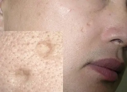 “Tái Sinh Làn Da” Trị mụn, sẹo lõm & thâm