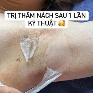 Triệt Mùi Hôi Nách – Nano