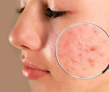 Chăm Da Mụn Lấy Nhân