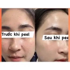 Peel tái tạo, căng bóng