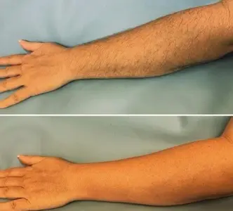 Waxing Nửa Cánh Tay