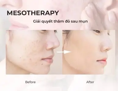 Mesotherapy – Rejuran Eye (S)