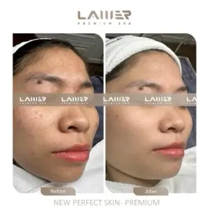 Mesotherapy – Acne