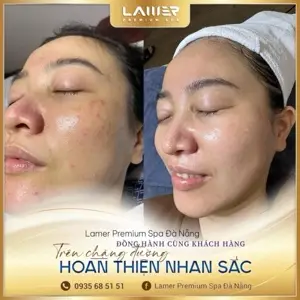 Mesotherapy – Skin Plumping/Glossy