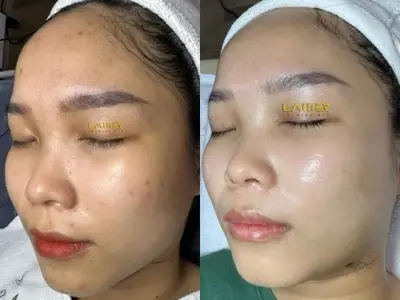 Acne Peel