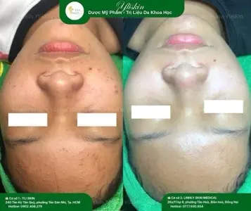 Acne Extraction Package 2 (Hidden Acne + Mild Inflammation – 10-Session Combo / 5 Months)