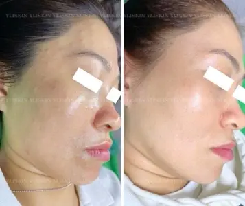 Facial Care Level 2 (5-Session Combo)