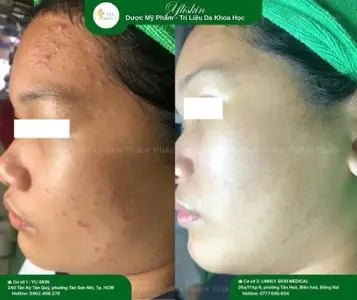Spot Acne Mesotherapy
