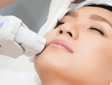 Upper Lip Hair Removal - 1 Year