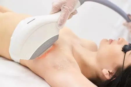 Underarm Hair Removal - 1 Year