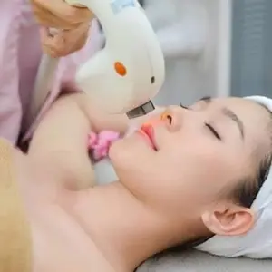 Upper Lip Hair Removal - 10 Sessions