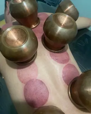 Cupping Ống Đồng Giải Hàn Khí - Mềm cơ