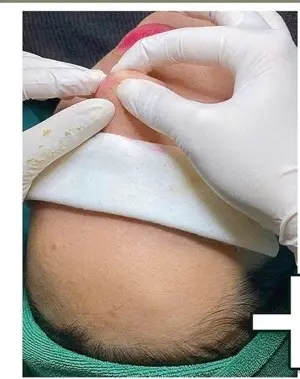Chemical Peel (Cơ bản)