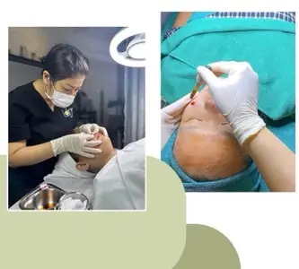 Chemical Peel + Nặn lần tiếp