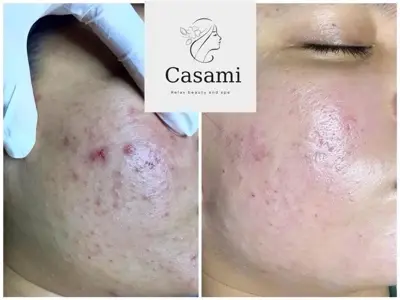 Acne Facial Care
