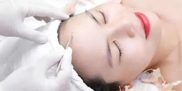 Lấy nhân mụn (nhiều)