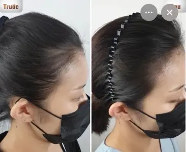 Hairline Shaping SMP / 1 session