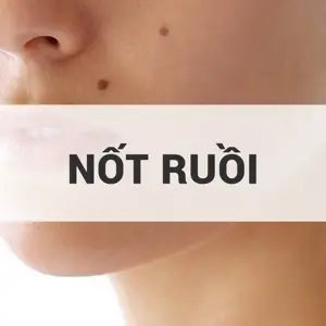 Large Mole Removal