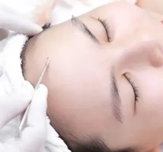 Deep Acne Treatment