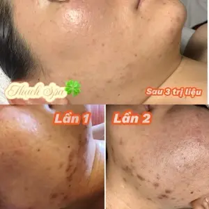 Điều Trị Mụn - Detox da