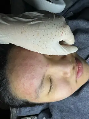 Lấy nhân mụn