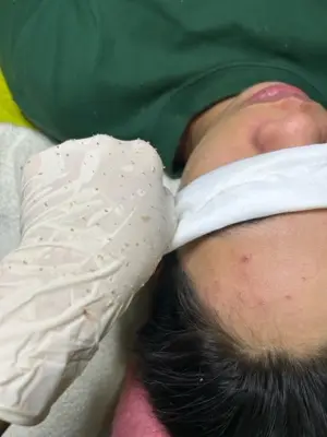 Acne Extraction