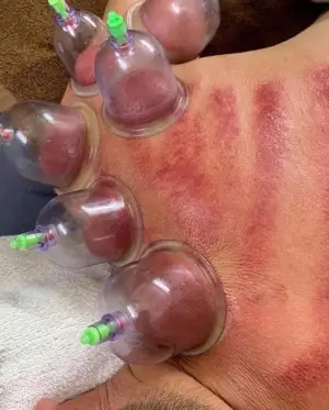 Cupping and scraping therapy