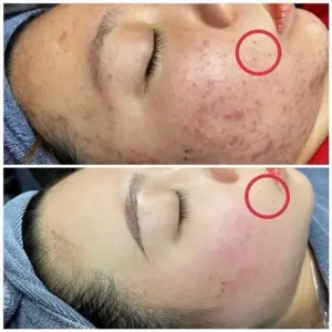 Mụn nâng cao + Detox