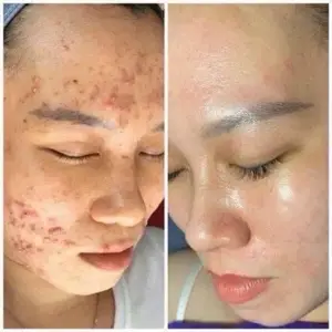 Mụn chuyên sâu + Phục hồi