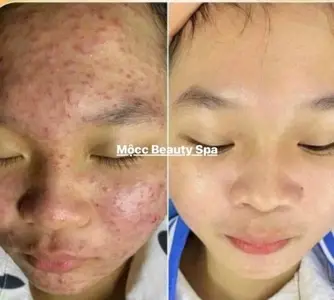 Mụn sạch