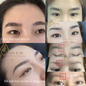 Xoá chân mày cũ 2 lần đầu 0đ