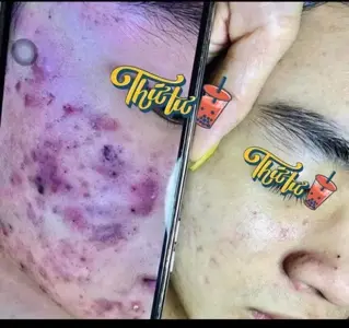 Acne Therapy