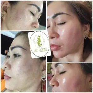 Pigmentation Treatment