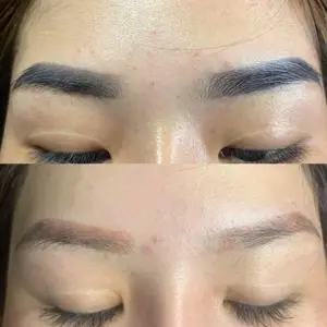 High-Tech Laser Removal + Complimentary Recovery Care