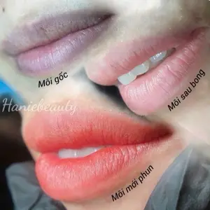 Khử thâm môi nam/nữ