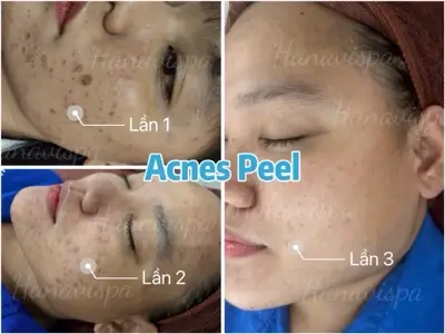 Acnes Peel