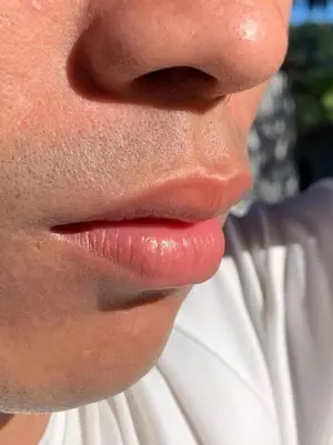 Male Dark Spot Lip Removal
