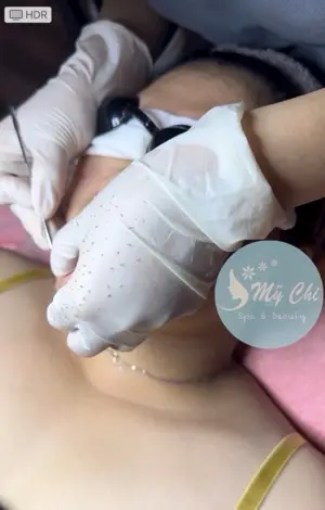 Điều trị mụn cơ bản